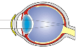 Терапия глаза при ношении контактных линз